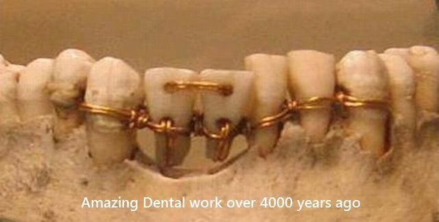 amazing dental work over 4000 years ago