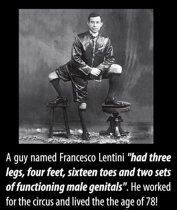 a guy named francesco lenten had three legs, four feet, sixteen toes and two sets of functioning male genitals, he worked for the circus and lived to the age of 78